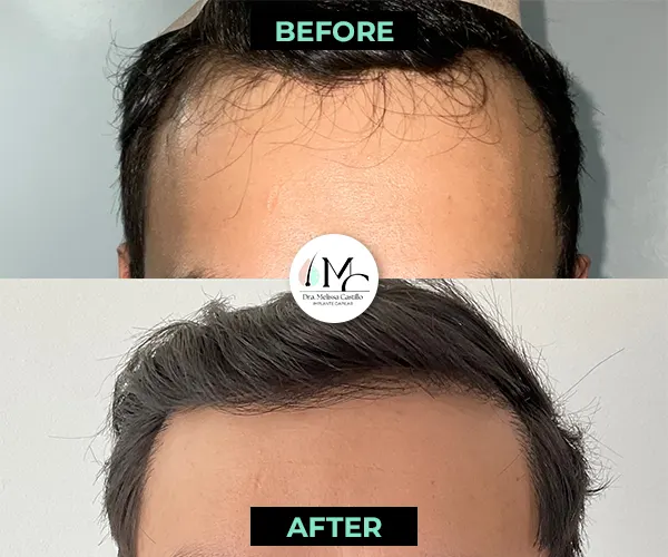 Img-Dra_Melissa_Castillo-Before&After-hairline-transplant-1 Img-Dra_Melissa_Castillo-Before&After-hairline-transplant-1