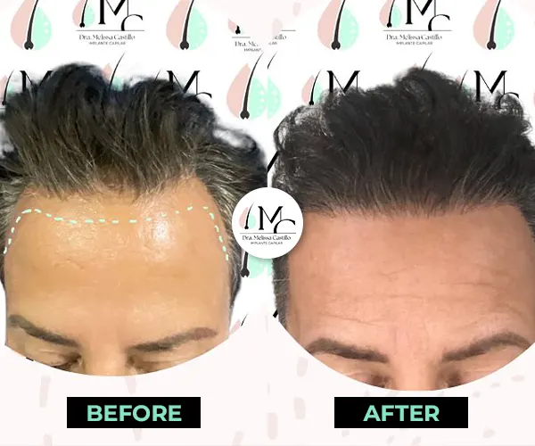 Img-Dra_Melissa_Castillo-Before&After-hairline-transplant-11 Img-Dra_Melissa_Castillo-Before&After-hairline-transplant-11