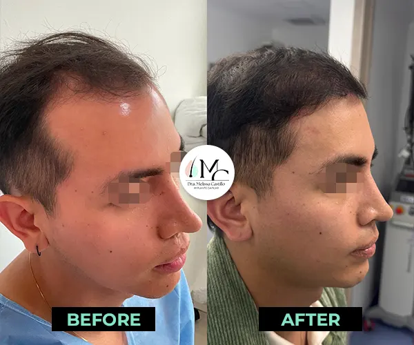 Img-Dra_Melissa_Castillo-Before&After-hairline-transplant-16 Img-Dra_Melissa_Castillo-Before&After-hairline-transplant-16