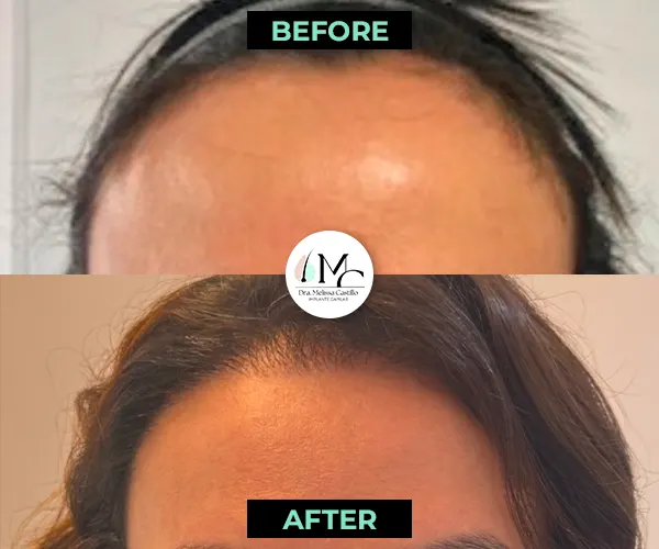 Img-Dra_Melissa_Castillo-Before&After-hairline-transplant-5 Img-Dra_Melissa_Castillo-Before&After-hairline-transplant-5
