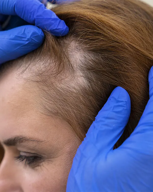 Img-hairline-transplant-in-bogota